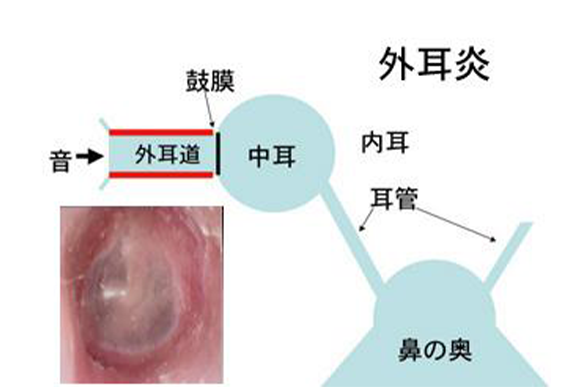 1.外耳炎