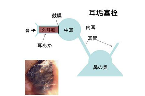 2.耳垢塞栓