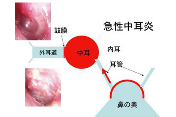 1.急性中耳炎