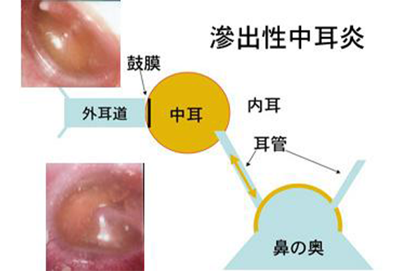 2.滲出性中耳炎