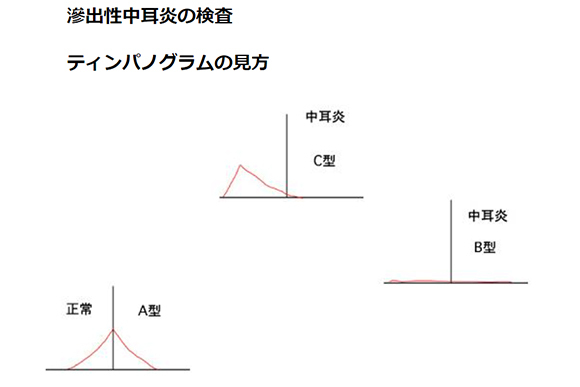 滲出性中耳炎の検査　ティンパノグラムの見方