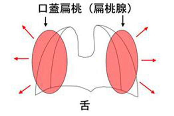 扁桃の炎症